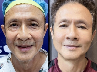 Căng Da Mặt: Tổng Quan Chuyên Sâu Các Phương Pháp Thẩm Mỹ Hiện Đại