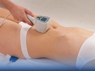 Hút Mỡ Bụng: Toàn Tập Từ A Đến Z Giúp Bạn An Tâm Làm Đẹp