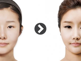 Phẫu Thuật Mũi: Tổng Quan Từ A Đến Z Về Các Phương Pháp