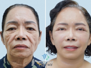 Thẩm Mỹ Căng Da Mặt: Bí Quyết Toàn Diện Lấy Lại Nét Thanh Xuân