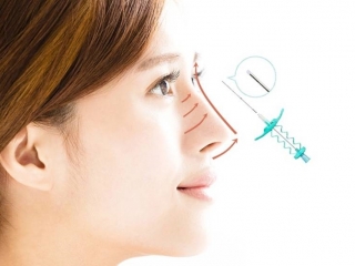 Nâng Mũi Chỉ: Giải Pháp Làm Đẹp Mũi Không Phẫu Thuật Có An Toàn Không?