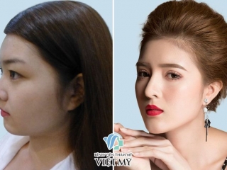 Độn Cằm: Từ A-Z Các Phương Pháp, Quy Trình Và Bí Quyết 