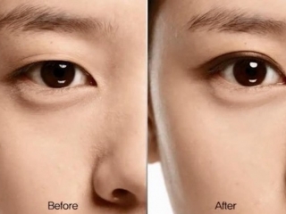 Lấy Mỡ Mắt: Kỹ Thuật, Quy Trình Chuẩn & Chi Phí Cập Nhật 2025