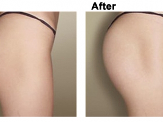 Nâng Mông: Giải Pháp Toàn Diện Để Sở Hữu Vòng 3 Hoàn Hảo Năm 2025