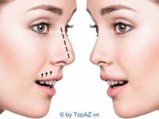 Nâng Mũi Bằng Chỉ Collagen Giải Pháp Thẩm Mỹ Hiện Đại Không Phẫu Thuật