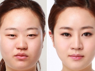 Hút Mỡ Mí Mắt: Giải Pháp Lấy Lại Đôi Mắt Trẻ Trung, Hết Sưng Mí Vĩnh Viễn