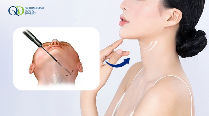 Tổng quan chuyên sâu về hút mỡ nọng cằm: Căn cứ khoa học và lợi ích thực tế