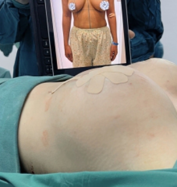 Nâng Treo Ngực Sa Trễ 