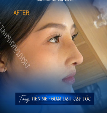 bác sĩ thẩm mỹ nâng mũi tại TP.HCM
