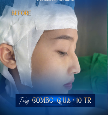 best rhinoplasty surgeon in Saigon