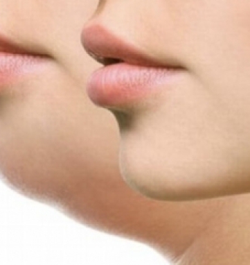 Hút Mỡ Nọng Cằm 