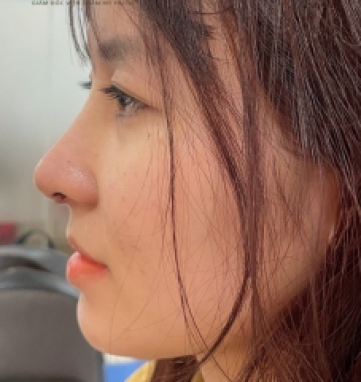 Nâng mũi cấu trúc