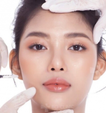 Tiêm Filler cân chỉnh tạo hình