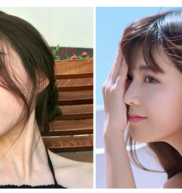 structural rhinoplasty in Saigon