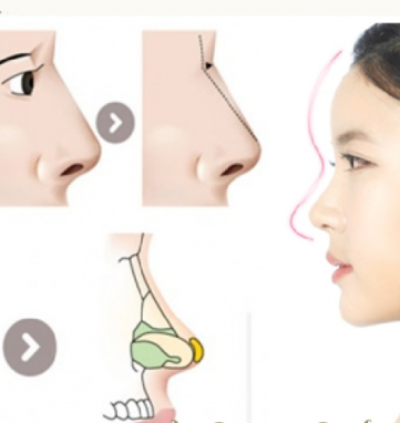 bác sĩ tư vấn nâng mũi tại Sài Gòn