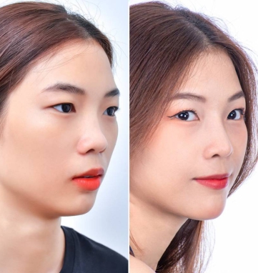 rhinoplasty consultation in Vietnam
