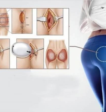 natural buttock augmentation in Ho Chi Minh City