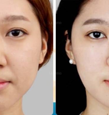 best nose surgeon in Ho Chi Minh City