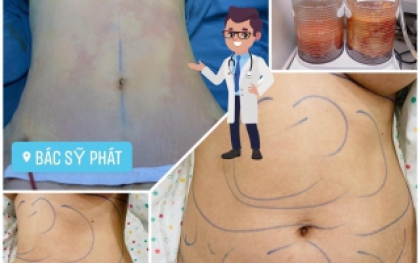 Hút mỡ là gì?