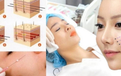 Căng da mặt toàn phần -  BS Thẩm Mỹ HUỲNH PHÁT