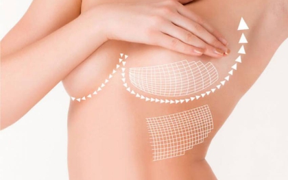 Có nên nâng ngực không và cần lưu ý những gì trước khi nâng?