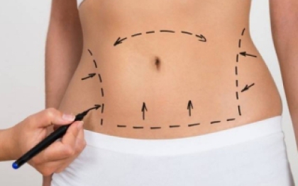 Hút mỡ - Điêu khắc body: Định hình vóc dáng hoàn hảo