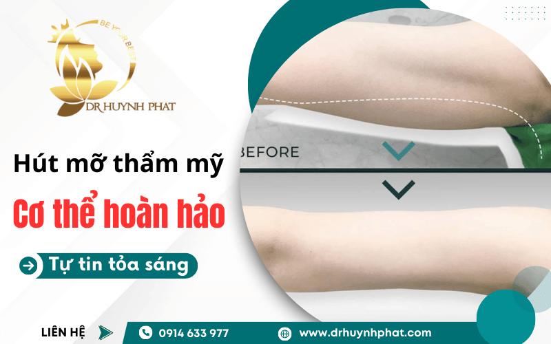 các vùng trên cơ thể có thể hút mỡ