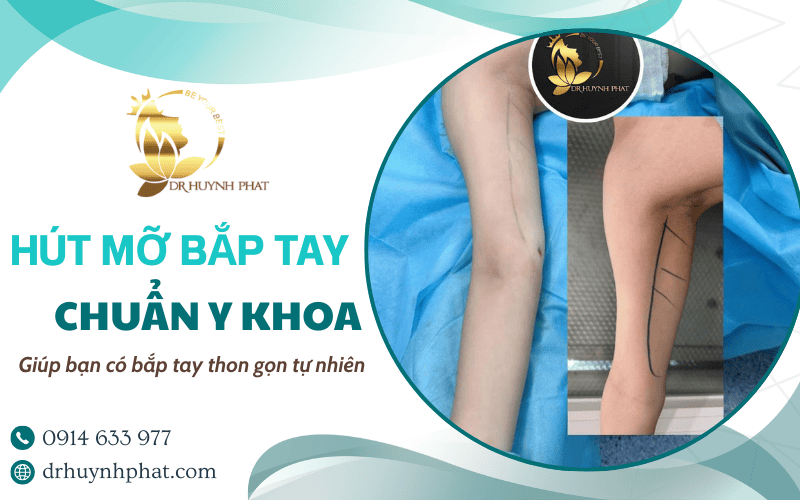 dịch vụ hút mỡ bắp tay